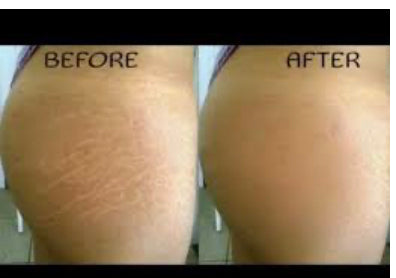Waist Slimming Cream